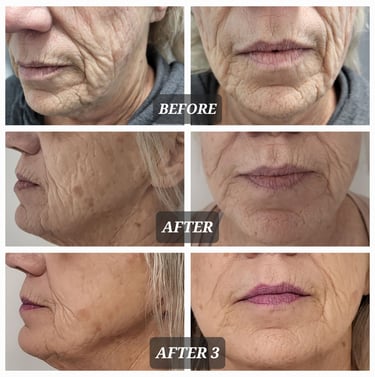 RF Microneedling coparison of facial skin rejuvenation showing reduced wrinkles and fine lines.