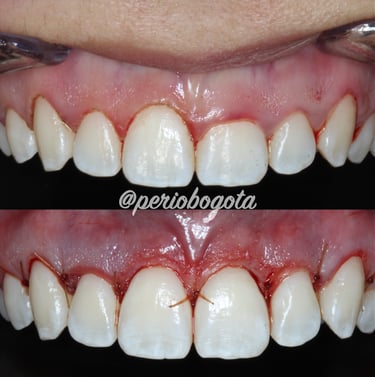 Tratamiento de estética gingival con modificación del contorno de las encías en sector anterior