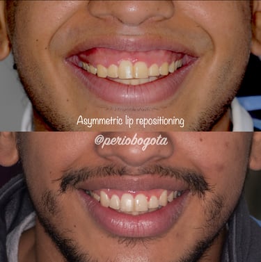 Procedimiento de reposicionamiento labial para reducción de la exposición gingival al sonreír