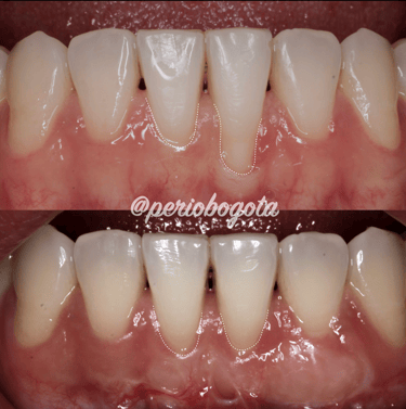 Procedimiento de cirugia mucogingival para mejorar la condicion periodontal