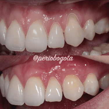 Cirugía plástica periodontal orientada a cobertura radicular y mejora del tejido gingival
