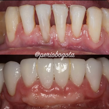 Tratamiento periodontal utilizado para mejorar la encia antes de las carillas