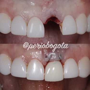 Tratamiento de dientes perdidos con implantes dentales y temporalizacion inmediata 