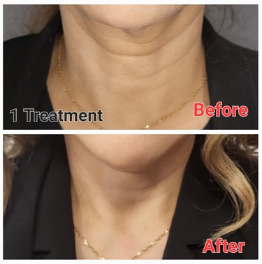 RF Microneedling results on neck skin tightening and reduced wrinkles after one aesthetic treatment.