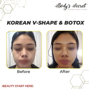 Body's Secret testimonial korean v shape and botox