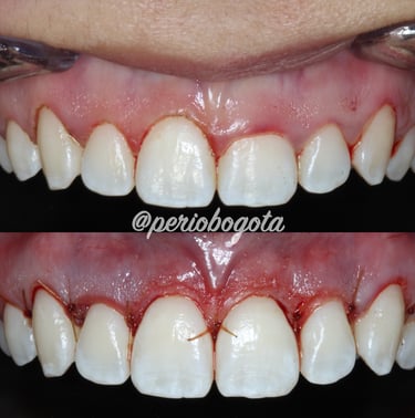 Tratamiento de estética gingival con modificación del contorno de las encías en sector anterior