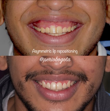 Procedimiento de reposicionamiento labial para reducción de la exposición gingival al sonreír