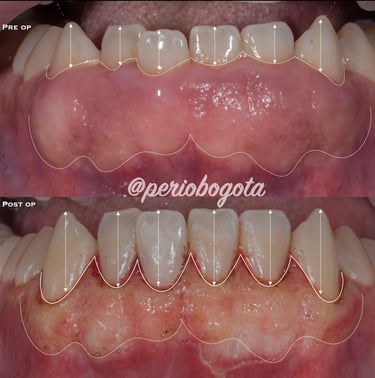 Tratamiento periodontal quirúrgico para la eliminacion de la encía sobrante e inflamada