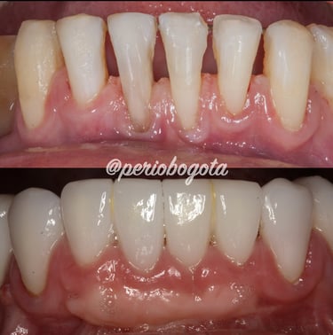 Tratamiento periodontal utilizado para mejorar la encia antes de las carillas