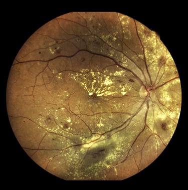 Diabetic Retinopathy