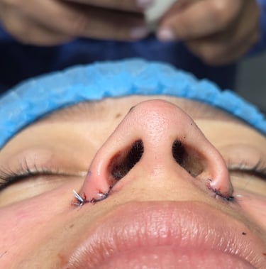 Rinomodelación con ácido hialurónico en clínica de armonización facial en Santo Domingo