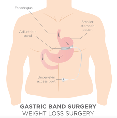gastric band