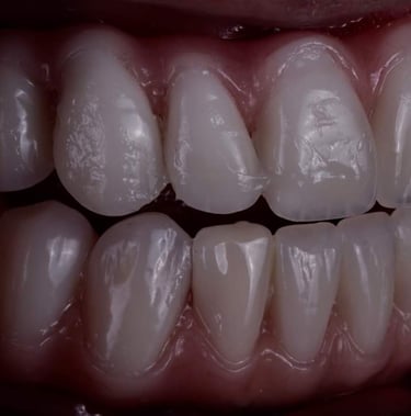 Prótese fixa de zircónia em caso de reabilitação complexa, planeada com precisão 3D.