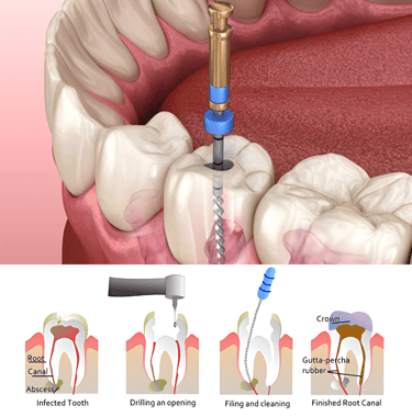 Root Canal Treatment near me |  Ekdantam Dental Clinic kopar khairane