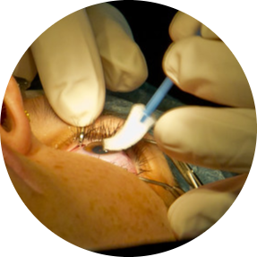 Cataract & Eye Surgeries
