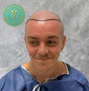 greffe de cheveux avant motif norwood 5
