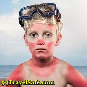 Dealing with Sunburns