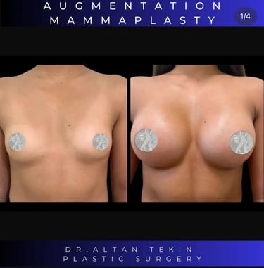 Breast Enhancement Turkey