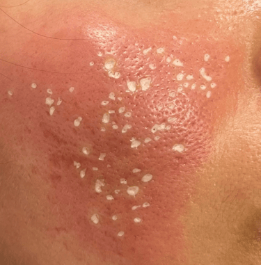 TCA cross chemical peel