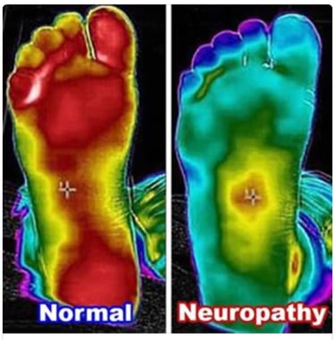 Thermal imaging showing neuropathy foot treatment at Made Ya Skinny med spa