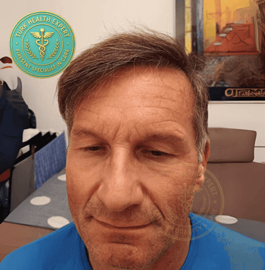 resultat de 1 ans apres la greffe de cheveux pour les seniors de plus de 50 ans