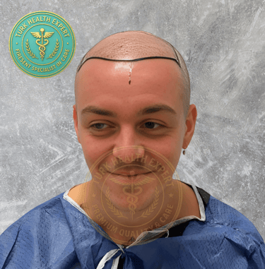 greffe de cheveux avant motif norwood 5