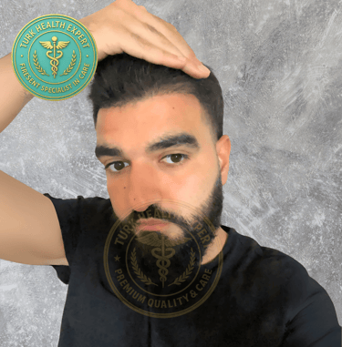 meme persone apres 3 mois de sa greffe de cheveux sans rasage DHI