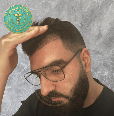 meme persone 15 jours apres sa greffe de cheveux sans rasage DHI