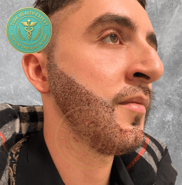 jeune homme 2 eme jour pres la greffe de barbe DHI