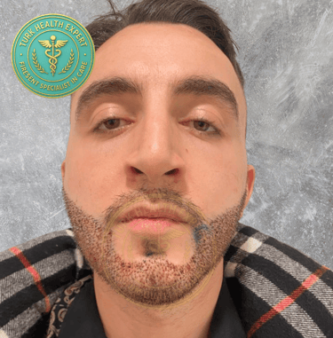 jeune homme 2 eme jour de la greffe de barbe
