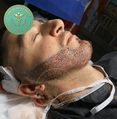 jeune homme avec la greffe de barbe