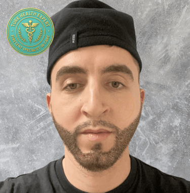 phot de jeune homme 15 jours apres la greffe de barbe