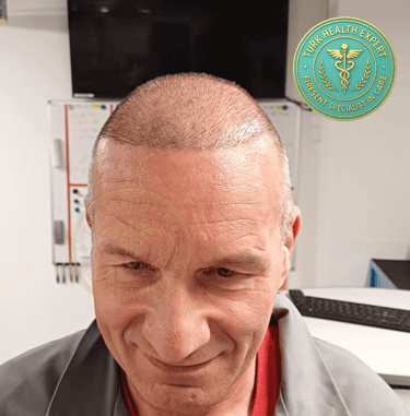 homme seniors de plus de 50 ans 15 jour apres la greffe de chevux