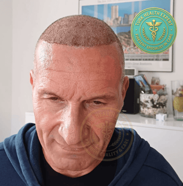 greffe de cheveux seniors apres 50 ans