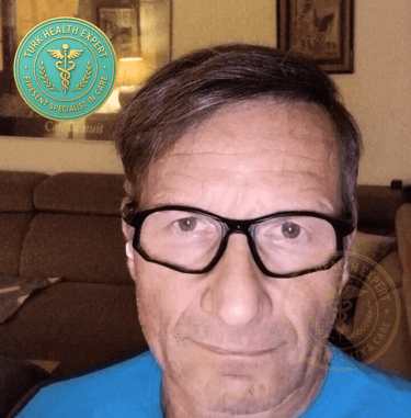 photo de 6 mois apres la Greffe de cheveux de homme de plus de 50 ans