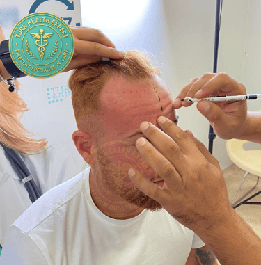 calvitie dans ligne frontale de patient de greffe de cheveux