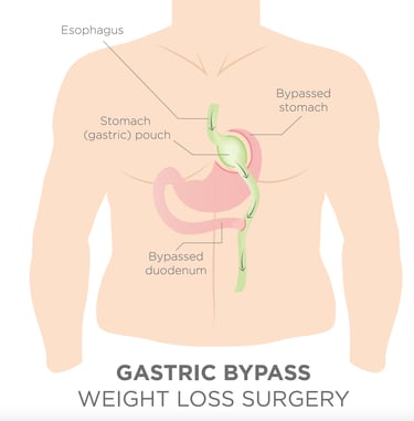 illustration of gastric bypass