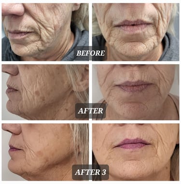 a woman's face before and after a RF Microneedling treatment