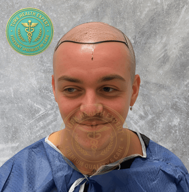 greffe de cheveux avant motif norwood 5