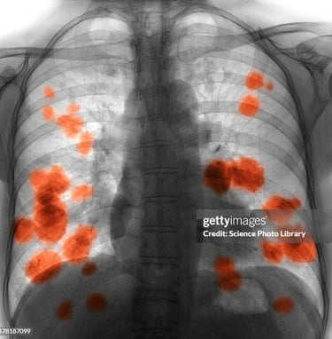 Getty Image of lung cancer
