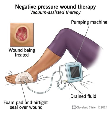 components of Negative Pressure Wound Therapy