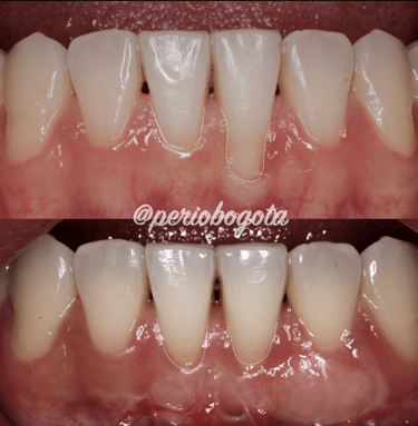 Procedimiento de cirugia mucogingival para mejorar la condicion periodontal
