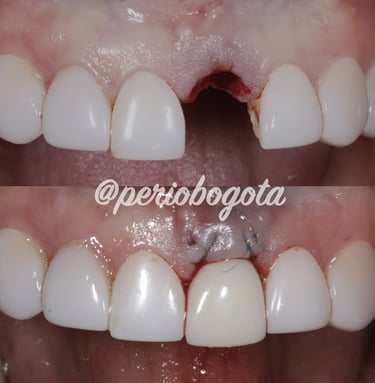 Tratamiento de dientes perdidos con implantes dentales y temporalizacion inmediata 