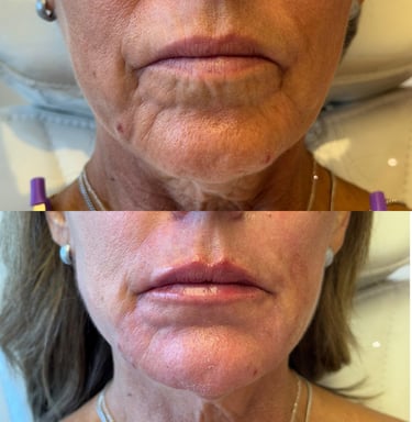 preenchimento labial viva clinica integrada estética avançada