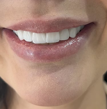 facetas de porcelana e tratamento dentario