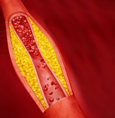 Representação esquemática de placas de gordura obstruindo as artérias do coração