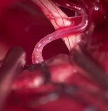 imagen microscopica de cerebro humna muestra una arteria y un nervio durante cirugia