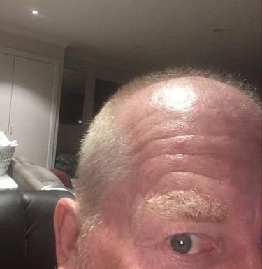 Martin Billington before his hair transplant