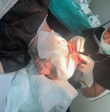 Extracting hair follicles for a hair transplant in Izmir, Turkey