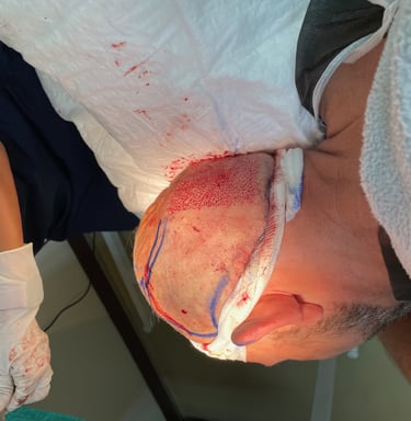 Extracting hair follicles for a hair transplant in Izmir, Turkey